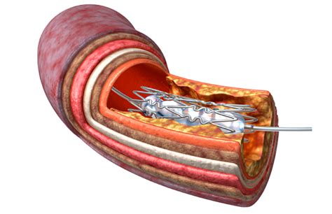 Chemoembolization | NorthShore