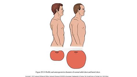 Barrel chest Diagram | Quizlet