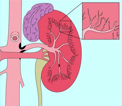 Renal artery stenosis | The BMJ