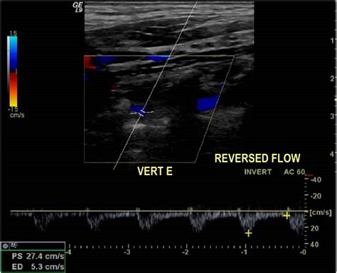 Figure 2 from An Update on Doppler Ultrasound of Vertebral Arteries: Subclavian Steal Syndrome ...