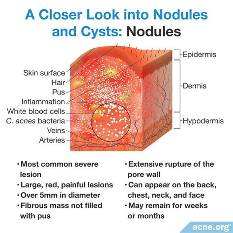 Mild Cystic Acne Diagram