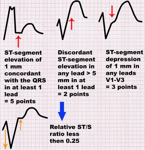 Sgarbossa and modified Sgarbossa criteria. At least 3 points of the ...