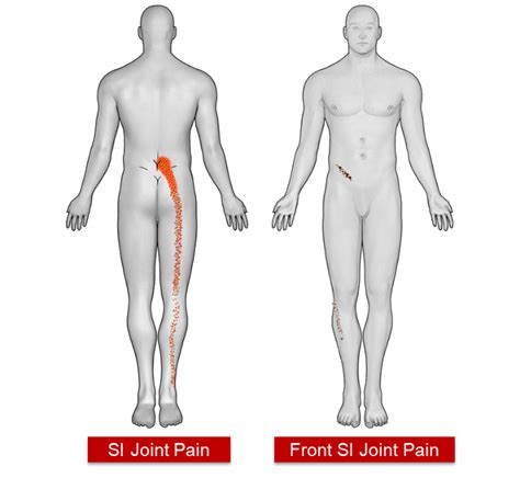 Sacroiliac Joint Dysfunction