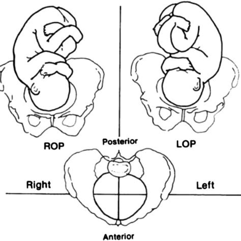 Fetal occipito-posterior (OP) position*. There are three OP positions:... | Download Scientific ...