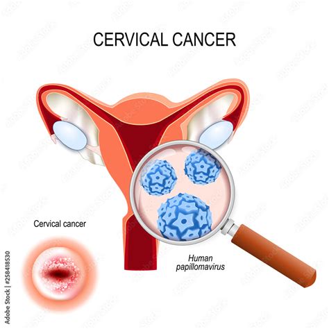 Cervical Cancer. Close-up of Human papillomavirus infection (HPV). cut ...