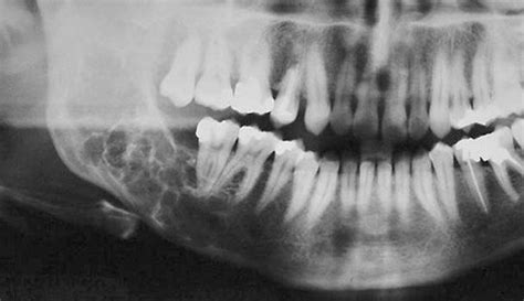 Relato de caso: Mixoma odontogênico - DRX Radiologia