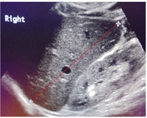 Sonogram illustrates liver span measurement which was performed at ...