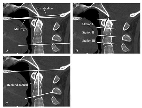 Atlantoaxial Instability