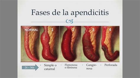 apendicitis