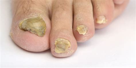 The Best Fungal Toe Nail Treatment - Taylors Lakes Podiatry Clinic