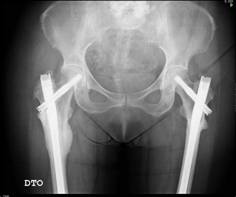 Bilateral atypical femoral fracture | Eurorad