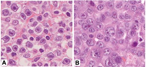 Cytomorphology of immunoblastic lymphoma. (A) IB lymphoma predominantly... | Download Scientific ...