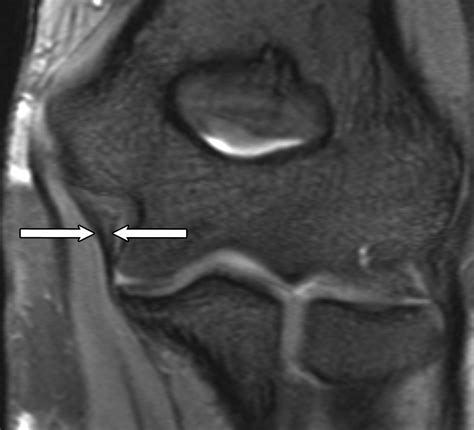 Ligaments and Plicae of the Elbow: Normal MR Imaging Variability in 60 ...