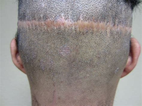 Fut Technique For Hair Transplant: A Comprehensive Guide In 2023 – MartLabPro