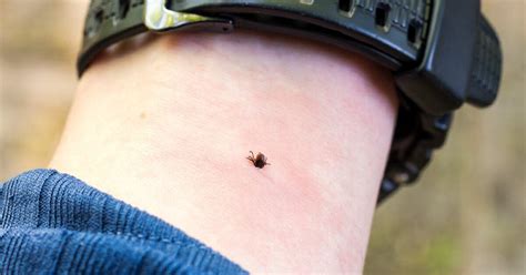 Tick Bites: Symptoms, Treatments, Pictures, and Prevention