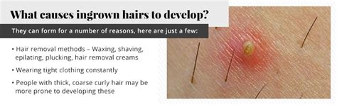 Best Hair Removal For Ingrown Hair Prone Skin - How To Get Rid Of ...