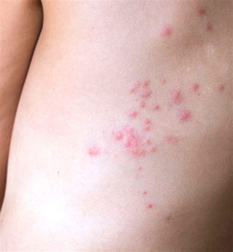 Bed bug bite symptoms and treatment - Patton Termite & Pest