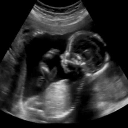 Ultrasound image of a baby in pregnant woman. | Download Scientific Diagram