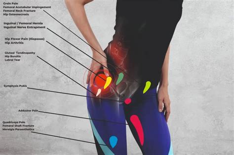 Hip Pain Location Diagram - Anterior, Posterior, Lateral View