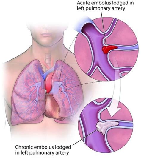 Chronic Thromboembolic Pulmonary Hypertension (CTEPH) | Temple Health