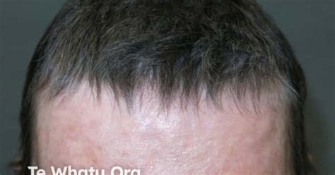 DermNet® - Anagen effluvium: regrowth after chemotherapy image