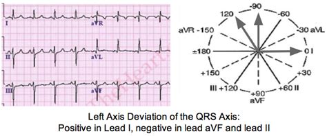 Left Anterior Fascicular Block (LAFB) ECG Review - Criteria and Examples | LearntheHeart.com