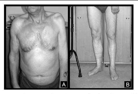 Figure 1 from Unilateral progressive muscular atrophy with fast symptoms progression. | Semantic ...