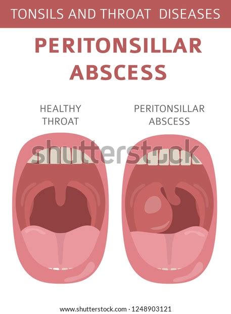 Tonsils Throat Diseases Peritonsillar Abscess Symptoms Stock Vector (Royalty Free) 1248903121