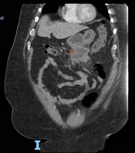 A Rare Case of Idiopathic Sclerosing Mesenteritis - MEDizzy Journal