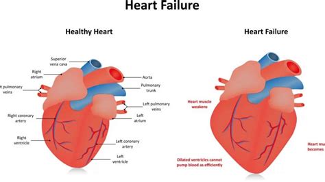 Hypokinesia and global hypokinesis of the left ventricle