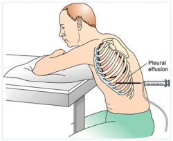 Pleural tap / Thoracentesis | Emergency Care Institute