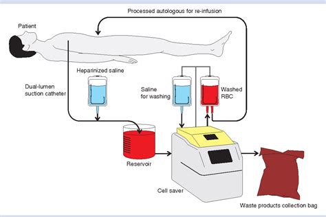 Cell salvage as part of a blood conservation strategy in anaesthesia ...