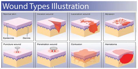 Wound and Its types - Overall Science