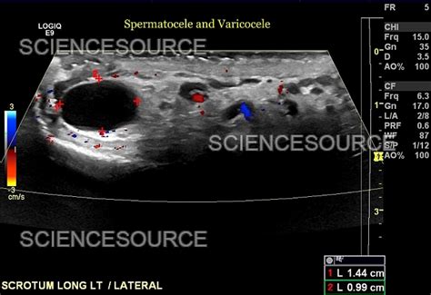 Spermatocele Ultrasound