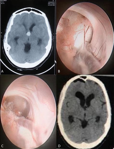 Lesions at the Foramen of Monro Causing Obstructive Hydrocephalus ...