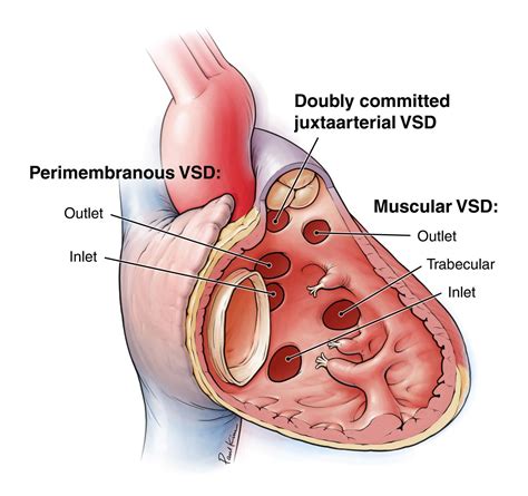 Ventricular Septal Defects (VSD) | Adult and Pediatric Cardiac