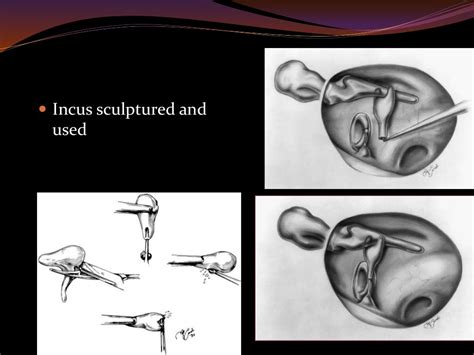 Ossiculoplasty