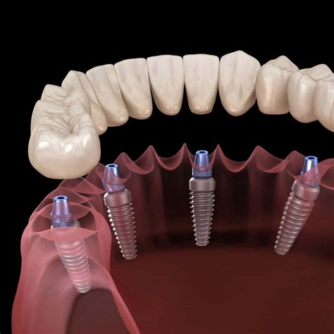 Implant Supported Dentures Hackensack, NJ - Designing Smiles