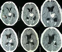 Hydrocephalus | Ct scan, Health blog, Weight plates