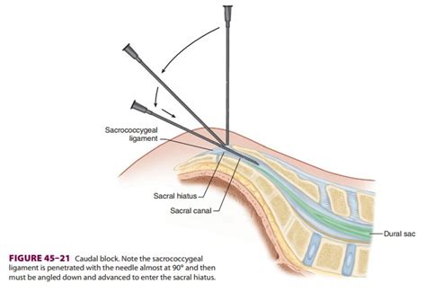 Caudal Anesthesia