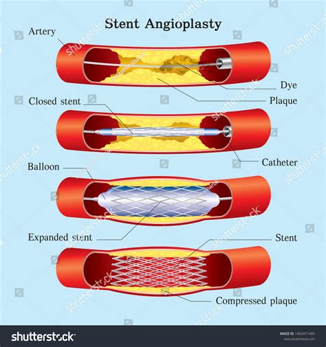 Stent Balloon Angioplasty Medical Graphic Stock Vector (Royalty Free) 1463471405 | Shutterstock