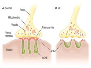 Disorders of Muscular System and Skeletal System: Arthritis, Fractures