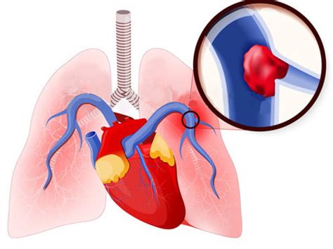 Saddle Pulmonary Embolism: Causes, symptoms, Treatment, Prevention ...