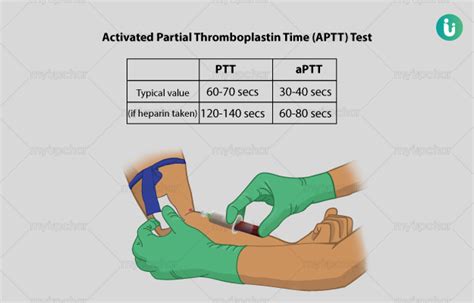 APTT (Activated Partial Thromboplastin Time) Test: Procedure, Purpose, Results, Normal values ...