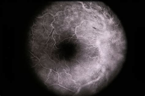 DUSN / Optic Papillitis - Retina Image Bank