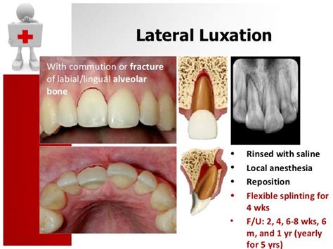 Traumatic Dental Injury and Treatment