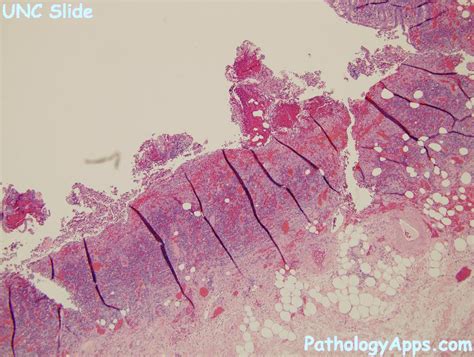 granulation tissue colon histology