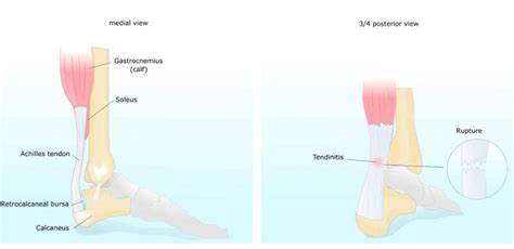 Achilles Tendon Lengthening (Surgery) | Pediatric Foot & Ankle