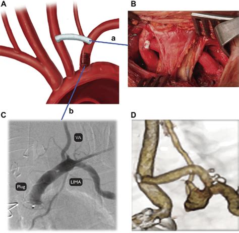 (A and B) In elective cases a left carotid-to-subclavian artery bypass... | Download Scientific ...