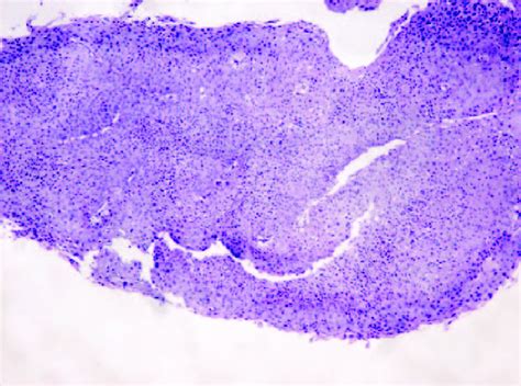 Histology section of Bowen's disease lesion. | Download Scientific Diagram